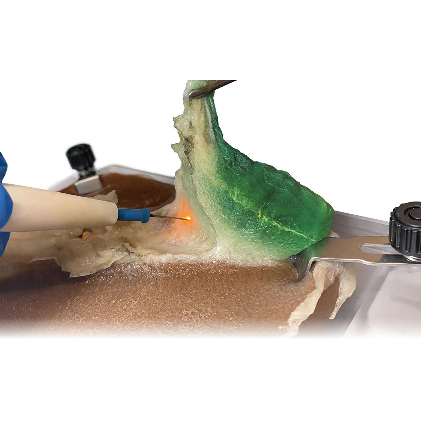 Plant-based synthetic gallbladder being surgically removed with an electrocautery device.