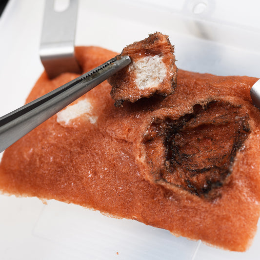 One white, dense tumor and its surrounding soft tissue are resected from the VTT Tumor Type using medical forceps and an electrocautery pencil.