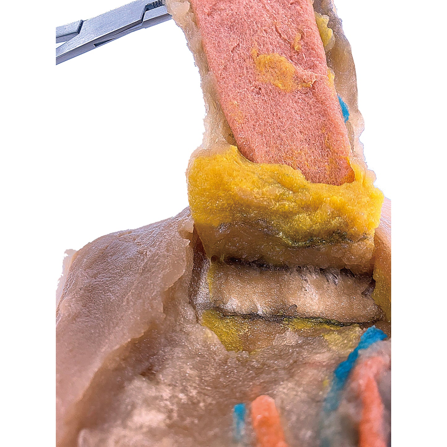 Lower Anterior Resection Model