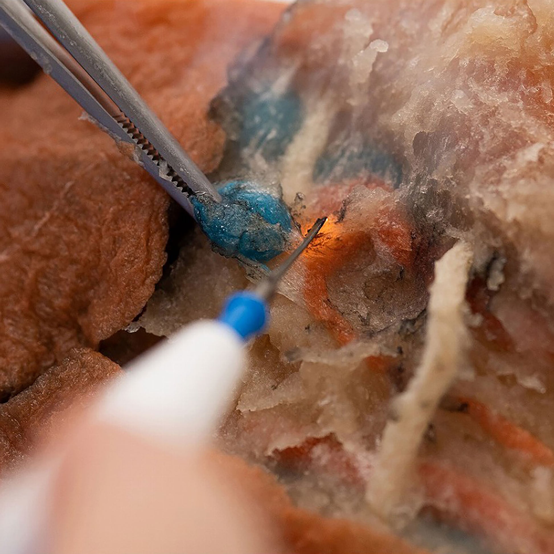 Lymph node resection training on the RBM2 Model using foreceps and an electrocautery pencil.