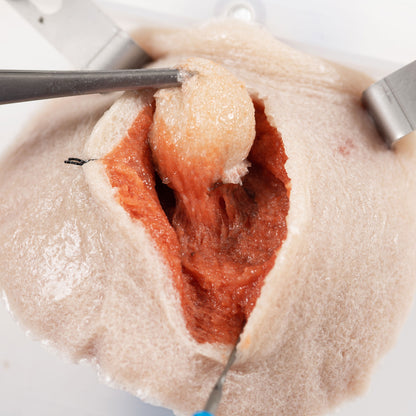 The tumor being removed from the Composite Tumor Model. Tissue still attached to the spherical tumor can be seen tearing as the tumor is pulled away with medical forceps. 